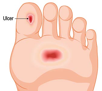 Diabetic Foot